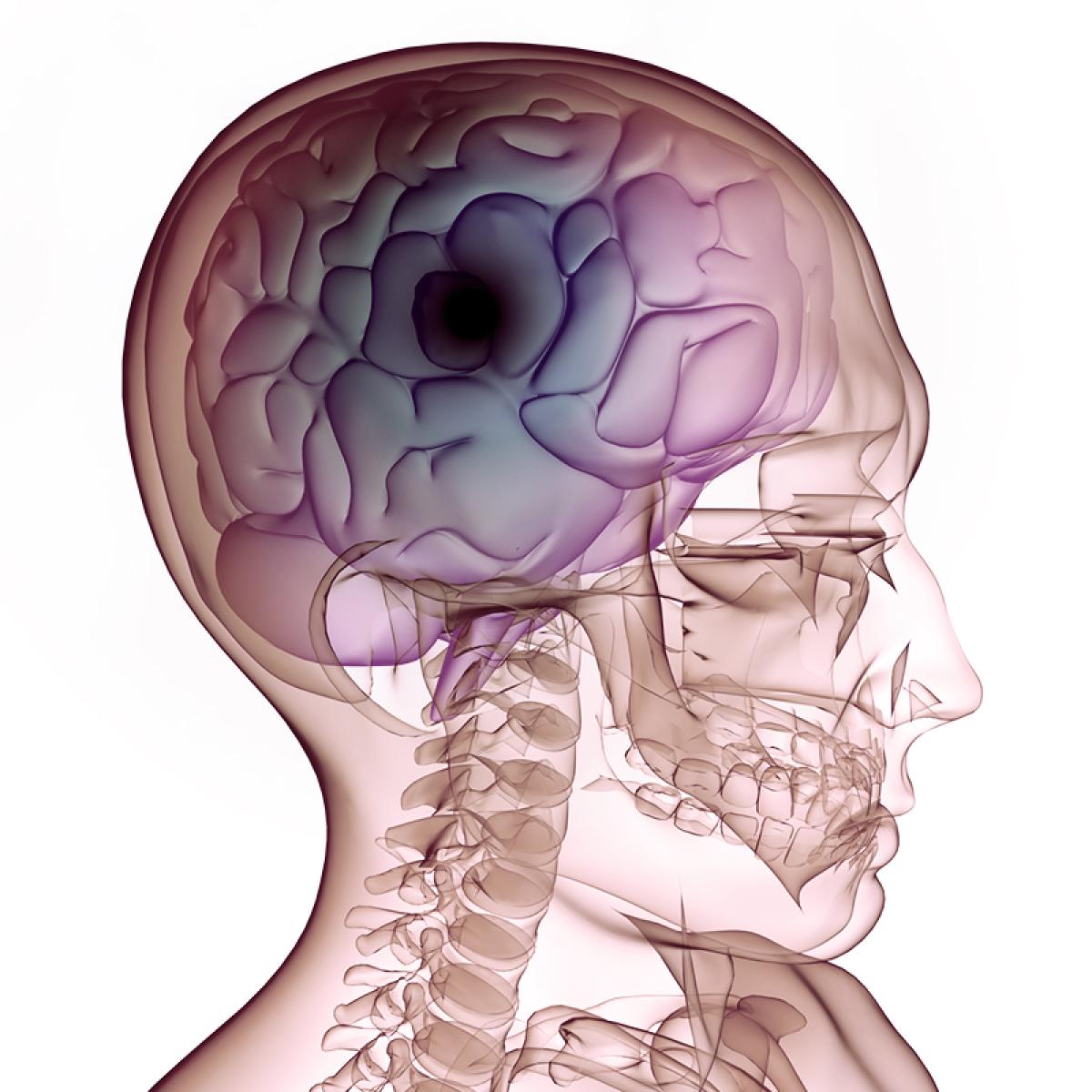 stem-cell-therapy-for-brain-injury-stemaid-institute